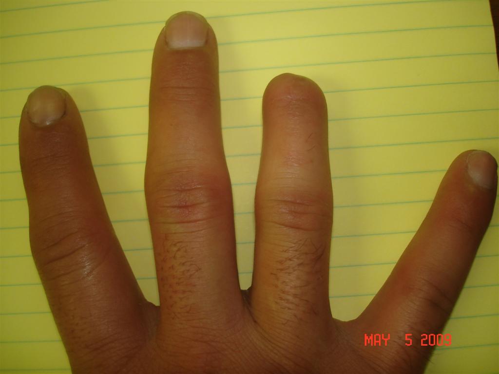 Amputation of Finger | Missouri Work Comp Scar and Disfigurement Lawyer